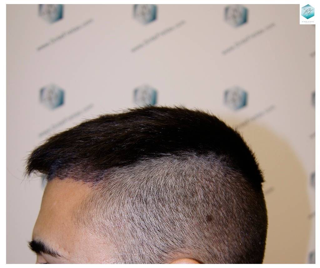 CLINICA DE FREITAS - 1683 GRAFTS FUE 16-En%209%20dias_zpsb6nxtr2y