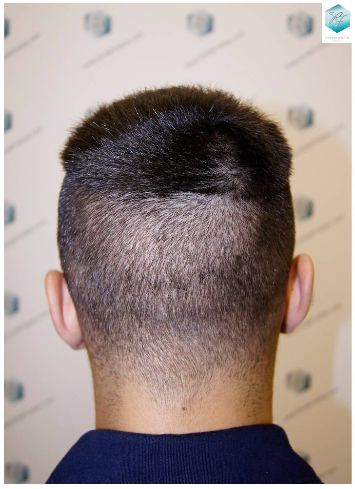 CLINICA DE FREITAS - 1683 GRAFTS FUE 17-En%209%20dias_zpsulf28gno