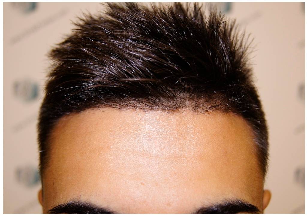 CLINICA DE FREITAS - 1683 GRAFTS FUE 18-En%203%20meses_zpsvyajshgw