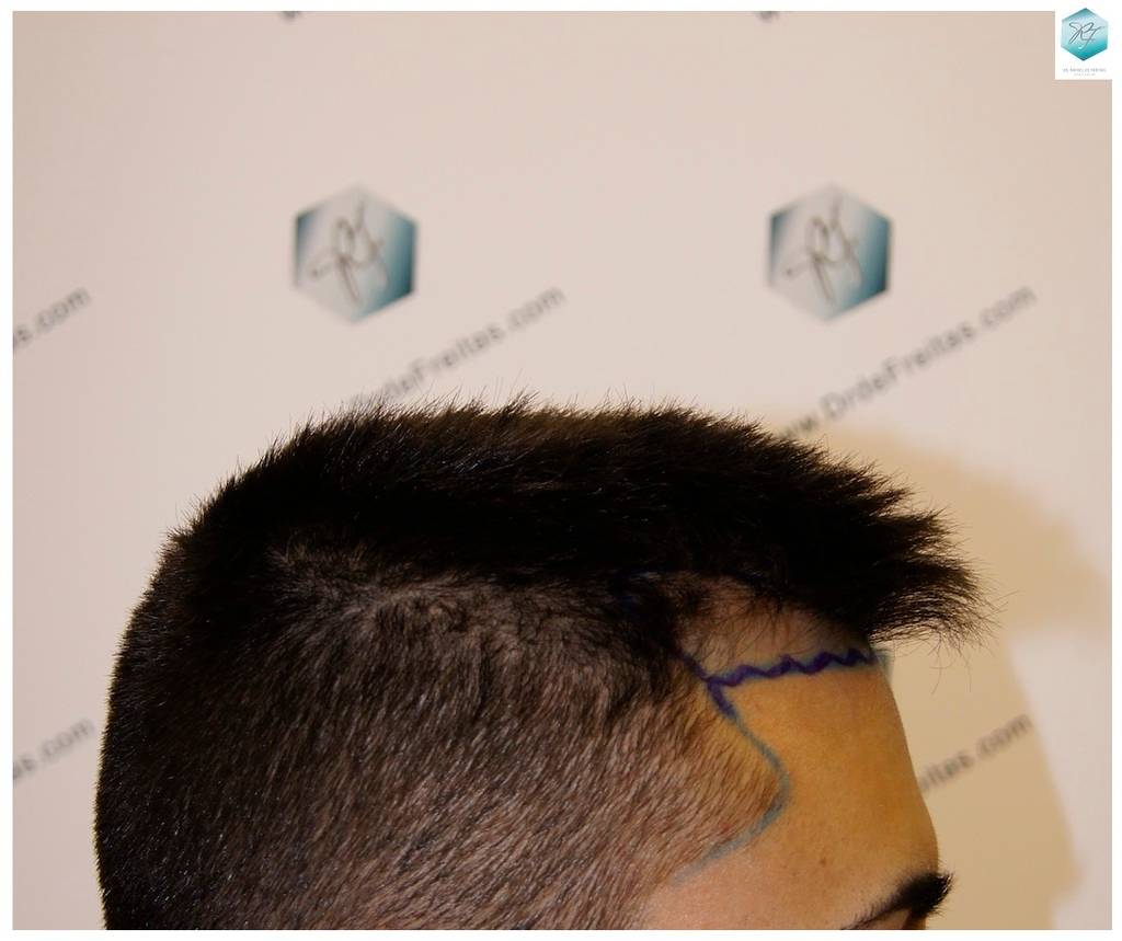 CLINICA DE FREITAS - 1683 GRAFTS FUE 2-Linea%20de%20Implantacion_zps8o2z3u57