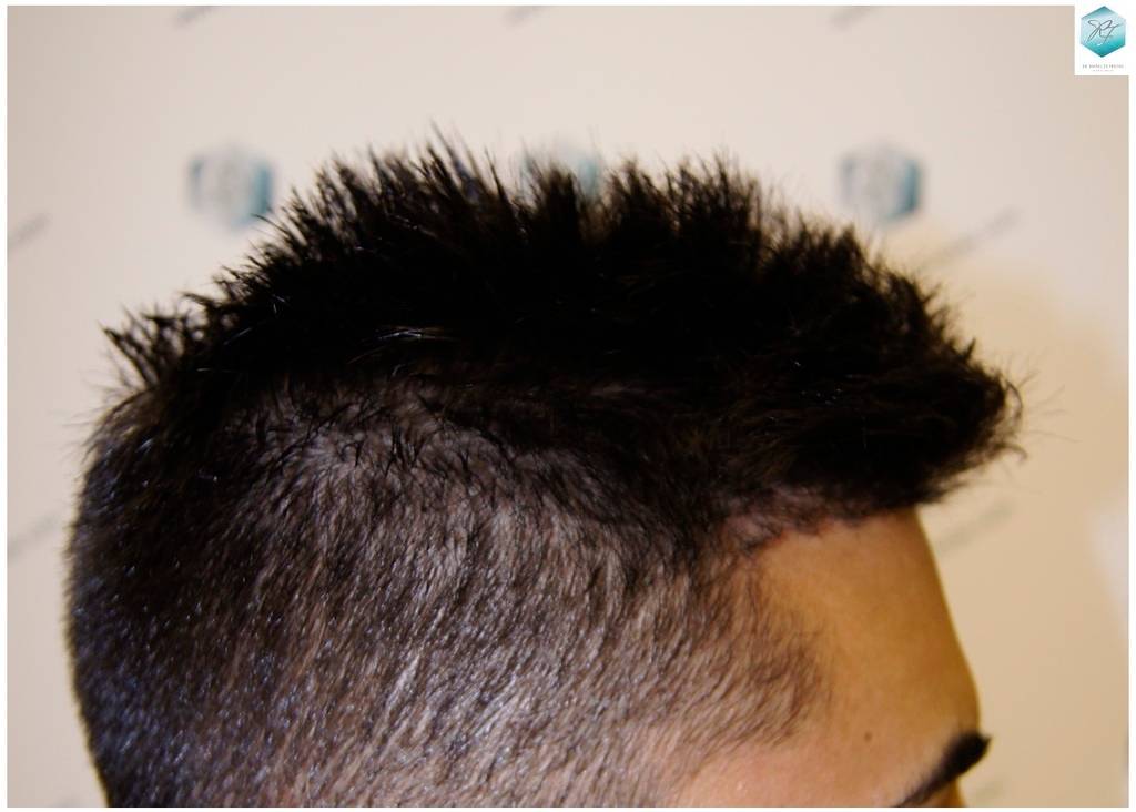 CLINICA DE FREITAS - 1683 GRAFTS FUE 20-En%203%20meses_zpssuapggff