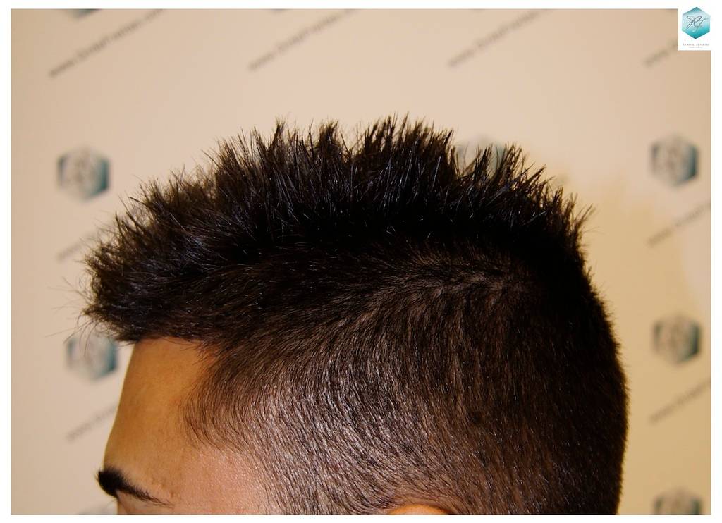 CLINICA DE FREITAS - 1683 GRAFTS FUE 21-En%203%20meses_zpsaijtvrqm