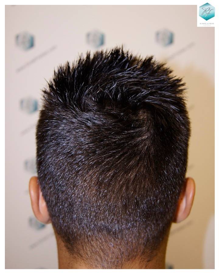 CLINICA DE FREITAS - 1683 GRAFTS FUE 22-En%203%20meses_zpsdoyex3tj