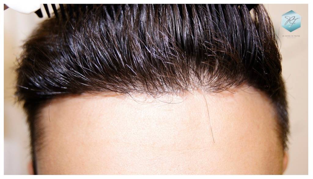 CLINICA DE FREITAS - 1683 GRAFTS FUE 23-En%209%20meses_zpszbe4vj7v