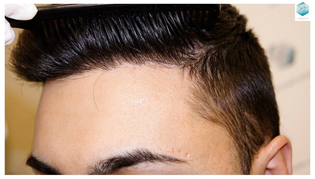 CLINICA DE FREITAS - 1683 GRAFTS FUE 25-En%209%20meses_zpsxpbi8v1e