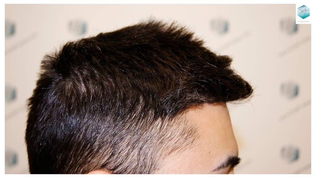 CLINICA DE FREITAS - 1683 GRAFTS FUE 26-En%209%20meses_zpsej5wa7uo