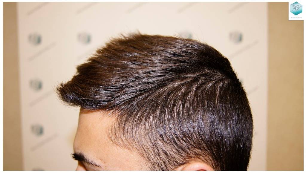 CLINICA DE FREITAS - 1683 GRAFTS FUE 27-En%209%20meses_zpslcprcrux