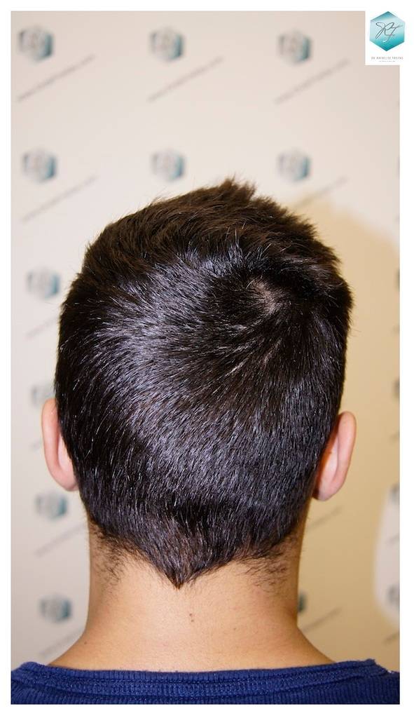 CLINICA DE FREITAS - 1683 GRAFTS FUE 28-En%209%20meses_zpsiayqogfq