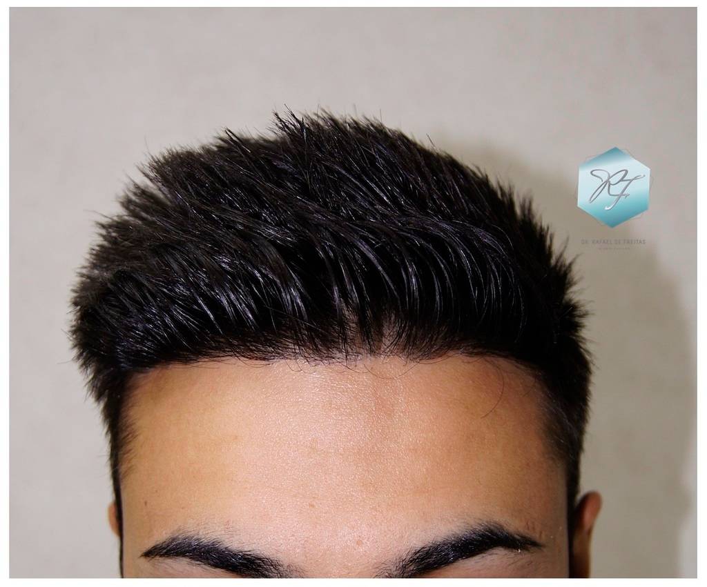 CLINICA DE FREITAS - 1683 GRAFTS FUE 29-En%201%20antildeo_zpsenycd5bj