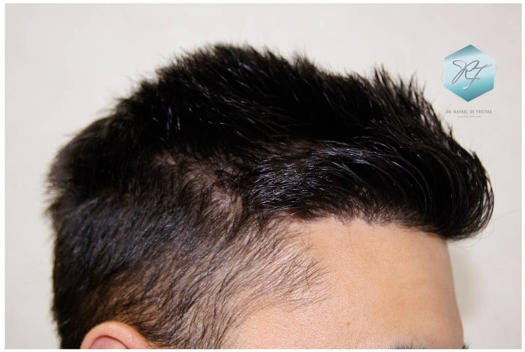 CLINICA DE FREITAS - 1683 GRAFTS FUE 31-En%201%20antildeo_zpssyy6jbql