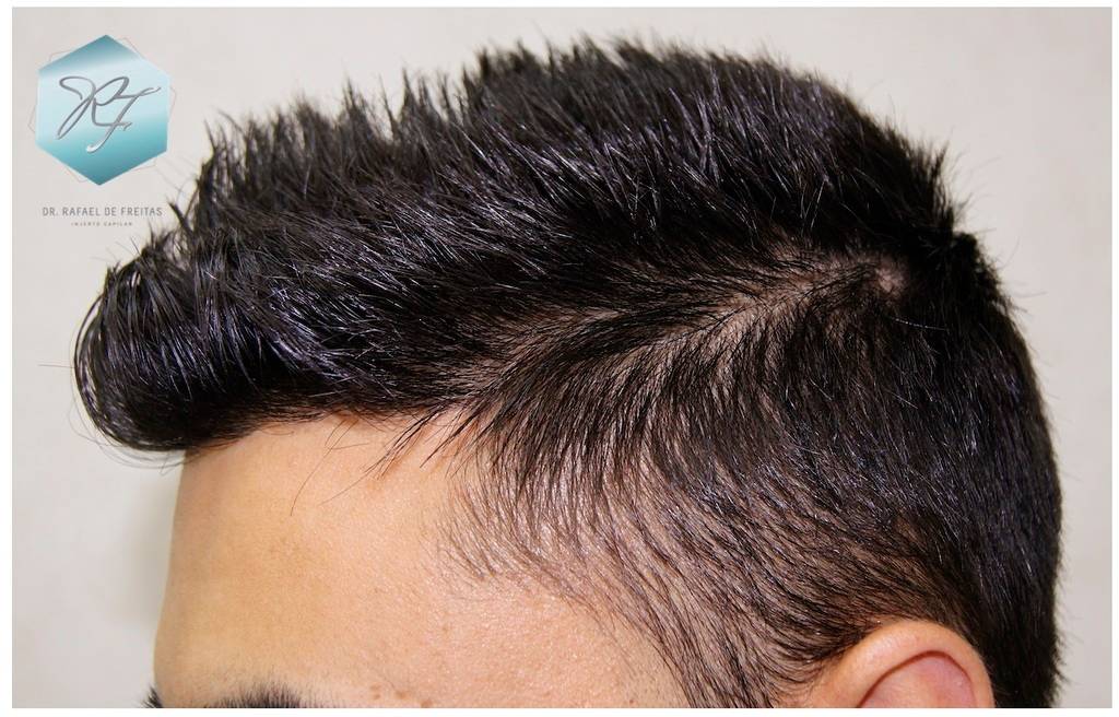 CLINICA DE FREITAS - 1683 GRAFTS FUE 32-En%201%20antildeo_zpsrlww8hhr