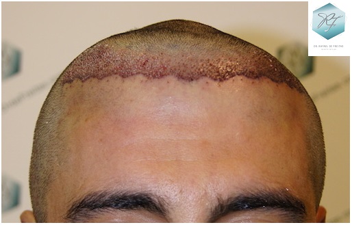 CLINICA DE FREITAS - 1870 GRAFTS FUE 10_zpshgh7icje