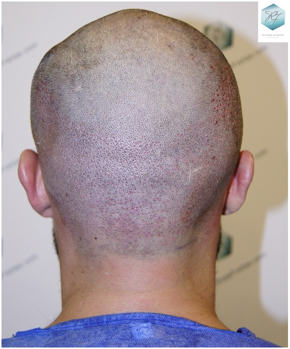 CLINICA DE FREITAS - 1870 GRAFTS FUE 16_zps92yil2hu