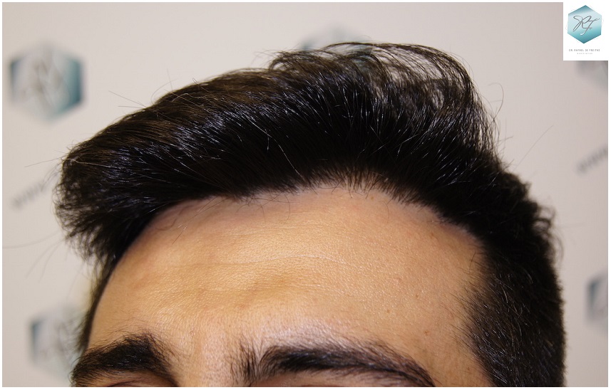 CLINICA DE FREITAS - 1870 GRAFTS FUE 18_zpsjp7qp2mk