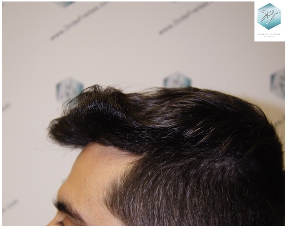 CLINICA DE FREITAS - 1870 GRAFTS FUE 19_zpsr3rtrgob