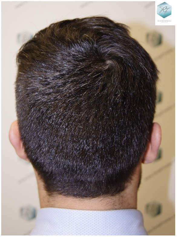 CLINICA DE FREITAS - 1870 GRAFTS FUE 21_zpsqxxgpc7x