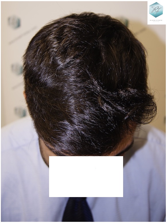 CLINICA DE FREITAS - 1870 GRAFTS FUE 22_zpsgdvgtidp