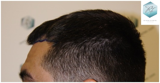 CLINICA DE FREITAS - 1870 GRAFTS FUE 2_zpsne2ucoco