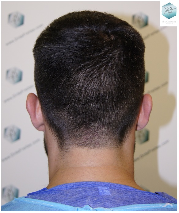 CLINICA DE FREITAS - 1870 GRAFTS FUE 4_zpsl2lnfpxk