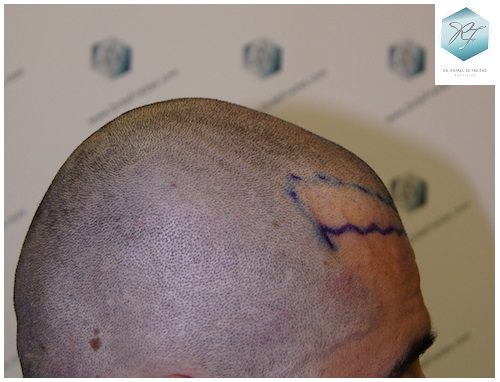 CLINICA DE FREITAS - 1870 GRAFTS FUE 8_zpsalmutryj