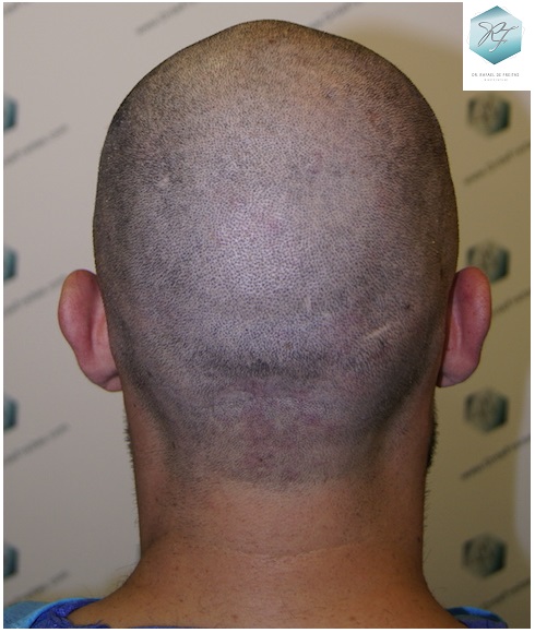 CLINICA DE FREITAS - 1870 GRAFTS FUE 9_zps9jkz4o4p