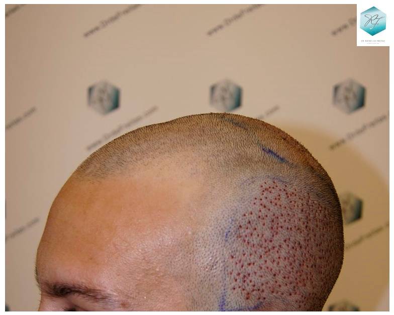 CLINICA DE FREITAS - 2036 GRAFTS FUE 11-Trasplante_zpslfjsnast