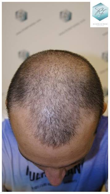 CLINICA DE FREITAS - 2036 GRAFTS FUE 15-En%2022%20dias_zpsohroozvn