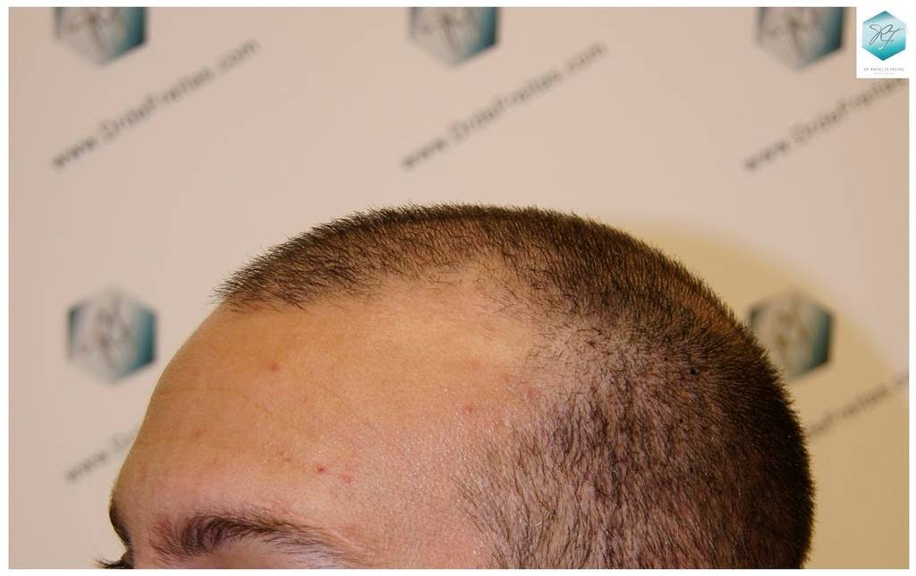 CLINICA DE FREITAS - 2036 GRAFTS FUE 17-En%2022%20dias_zpscyd2u3p3