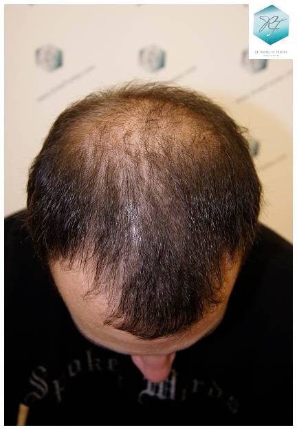 CLINICA DE FREITAS - 2036 GRAFTS FUE 23-En%203%20meses_zpsbykzvs3m