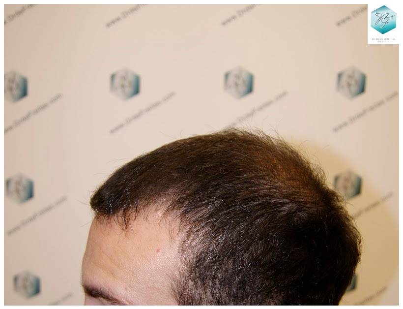 CLINICA DE FREITAS - 2036 GRAFTS FUE 25-En%203%20meses_zpsgtndvvwu