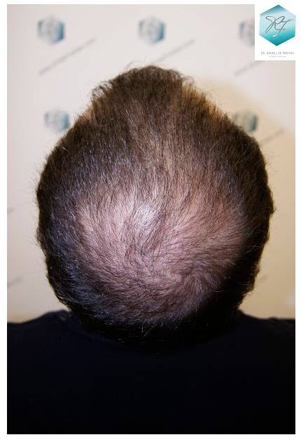 CLINICA DE FREITAS - 2036 GRAFTS FUE 28-En%203%20meses_zpsv61tamgz