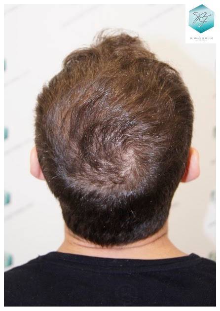 CLINICA DE FREITAS - 2036 GRAFTS FUE 32-En%209%20meses_zpscj3gkvii