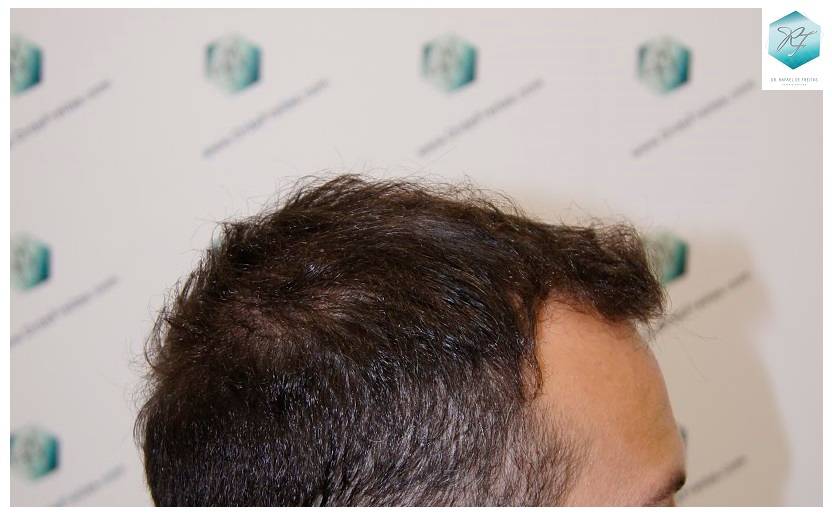 CLINICA DE FREITAS - 2036 GRAFTS FUE 33-En%209%20meses_zpsflt6lnrx