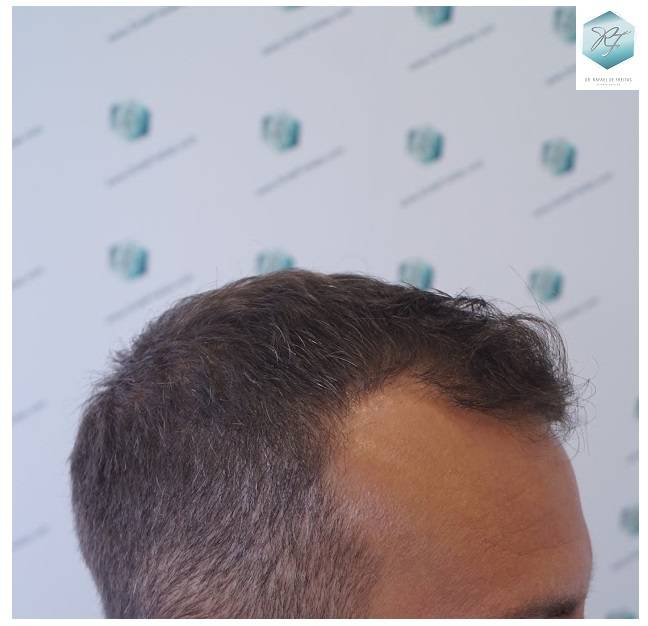 CLINICA DE FREITAS - 2036 GRAFTS FUE 35-En%2016%20meses_zpspewp57hl