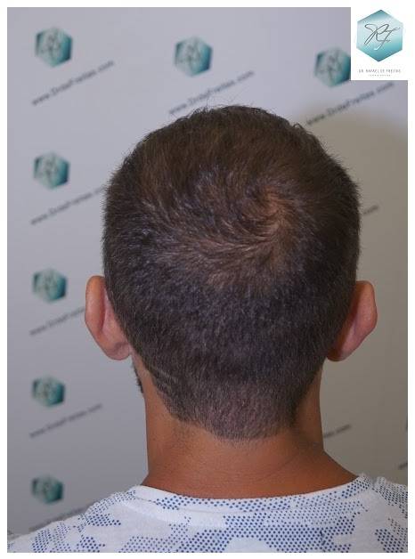 CLINICA DE FREITAS - 2036 GRAFTS FUE 37-En%2016%20meses_zps7bpswj9u