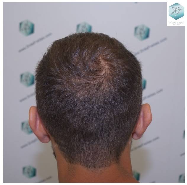 CLINICA DE FREITAS - 2036 GRAFTS FUE 38--En%2016%20meses_zpsavuyrkl4