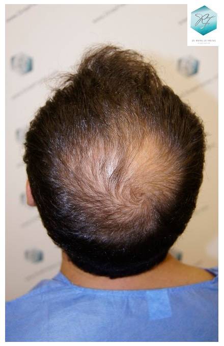 CLINICA DE FREITAS - 2036 GRAFTS FUE 4-Antes_zpshqrcdrga