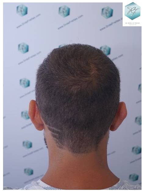 CLINICA DE FREITAS - 2036 GRAFTS FUE 40-En%2016%20meses_zpsdwzsdtho