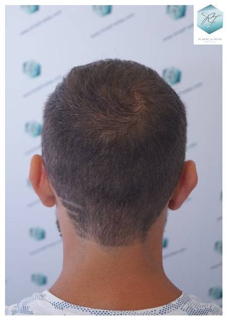 CLINICA DE FREITAS - 2036 GRAFTS FUE 41-En%2016%20meses_zpsn0dmygmz