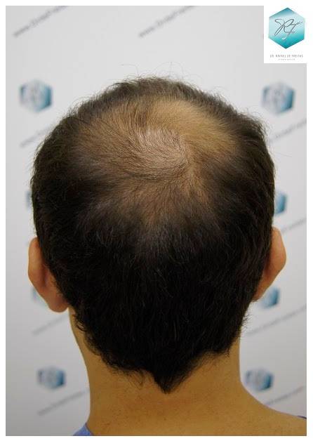 CLINICA DE FREITAS - 2036 GRAFTS FUE 5-Antes_zpsvmv34uxs