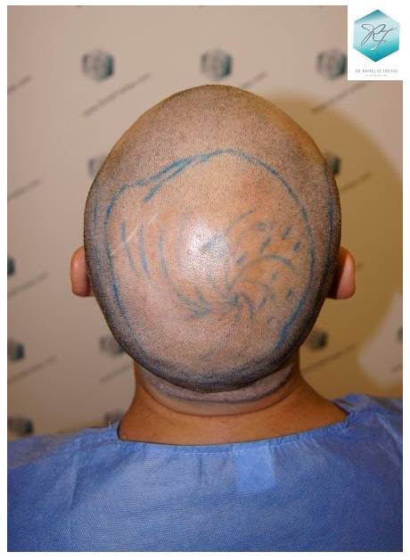 CLINICA DE FREITAS - 2036 GRAFTS FUE 9-Disentildeo_zpsten9lrlc