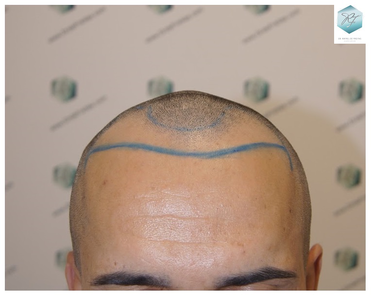 CLINICA DE FREITAS - 2077 GRAFTS FUE 10_zpsyhuu4ima