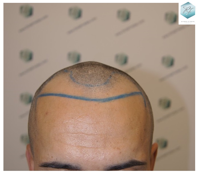 CLINICA DE FREITAS - 2077 GRAFTS FUE 11_zpsyp5zjc4l