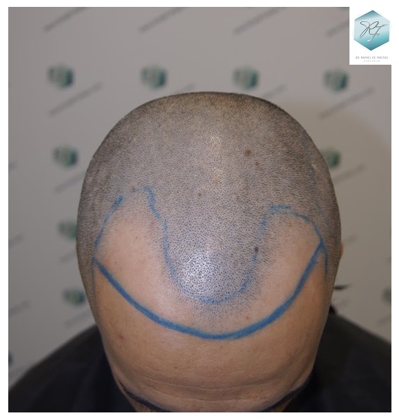 CLINICA DE FREITAS - 2077 GRAFTS FUE 12_zpsa7bcnq5a