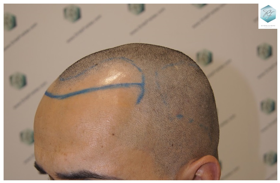 CLINICA DE FREITAS - 2077 GRAFTS FUE 13_zps2jqjglif