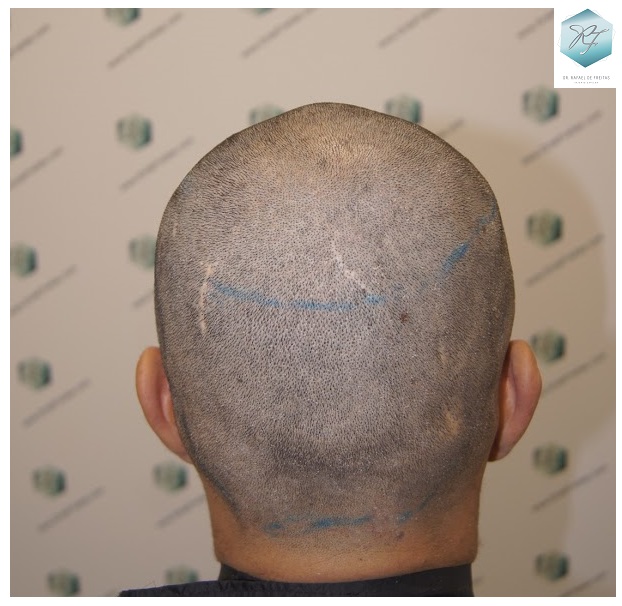 CLINICA DE FREITAS - 2077 GRAFTS FUE 15_zpsd8lkp6f9