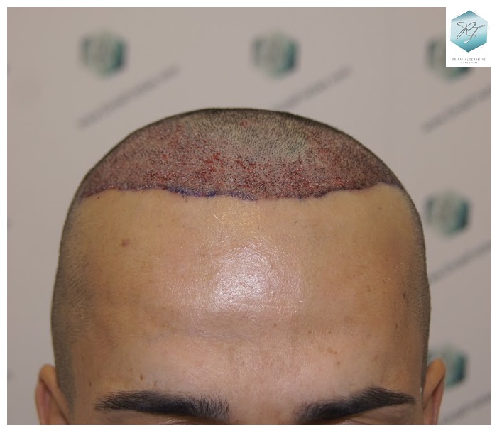 CLINICA DE FREITAS - 2077 GRAFTS FUE 16_zpstgj0euma