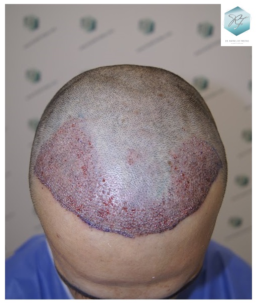 CLINICA DE FREITAS - 2077 GRAFTS FUE 18_zpsqzo1ptv7