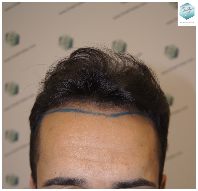 CLINICA DE FREITAS - 2077 GRAFTS FUE 1_zpsuw2ybnzs