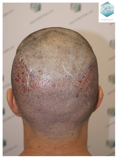 CLINICA DE FREITAS - 2077 GRAFTS FUE 22_zpskm5kyjdd